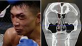 UFC’s Song Yadong posts X-ray of fractured orbital from Cory Sandhagen fight: ‘I was seeing triple’
