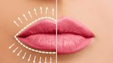 El error con el relleno de labios que tiene a muchas mujeres desesperadas