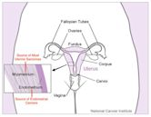 Uterine cancer