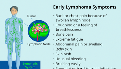 What Is Lymphoma, and Is It Serious?