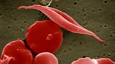 Study: Sickle cell disorder patients less likely to get full COVID-19 vaccine dosage