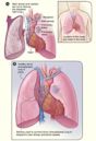 Lung transplantation