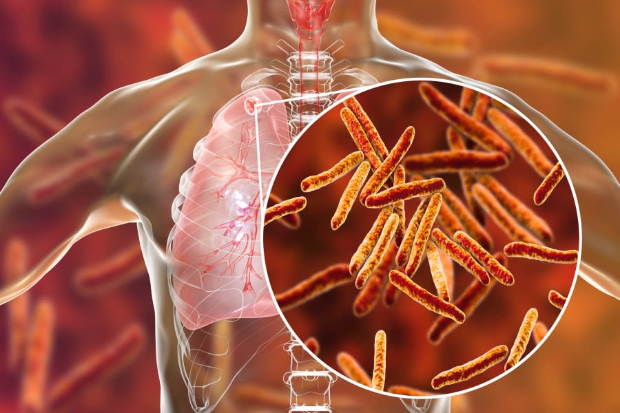 Tuberculosis case confirmed at Chester High School: DHEC