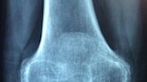 Naturally-occurring peptide shows promise as new therapeutic in bone repair