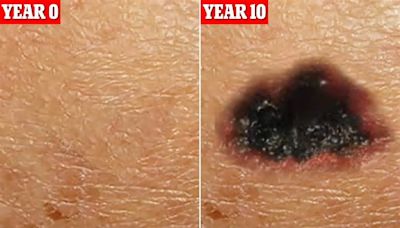 Alarming time-lapse reveals how tiny 'dark patch' becomes melanoma