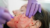 How ‘vampire facials’ at an unlicensed spa left three women with HIV