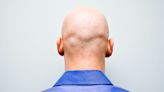 Baldness 'could be cured by a sugar that naturally occurs in the body'