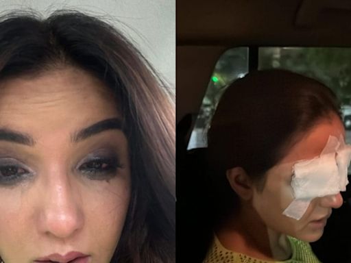 Jasmin Bhasin Shares Update After She Suffers Corneal Damage Due To Lens Mishap: 'Can't See Properly' - News18