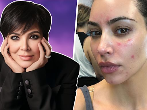 Las enfermedades que Kim Kardashian y su familia ocultaban: tumores, manchas rojas y más