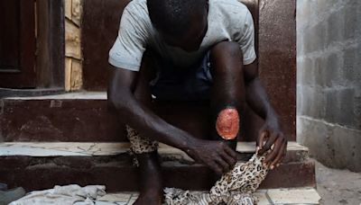 El 'kush', la nueva droga que devasta a los jóvenes de Sierra Leona