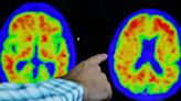 Acumen's Alzheimer's drug passes initial safety test