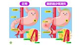 一吃就吐、體重驟降！ 罕見「十二指腸遭夾」不治療恐致殘