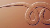 Family Reunion Left 3 People Hospitalized With Rare Parasitic Worms, CDC Reports