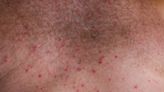 Texas ‘a breeding ground for’ heat rash, says dermatologist. Some tips on treating ailment