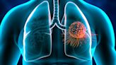 AstraZeneca’s Tagrisso gains approval in Canada for NSCLC