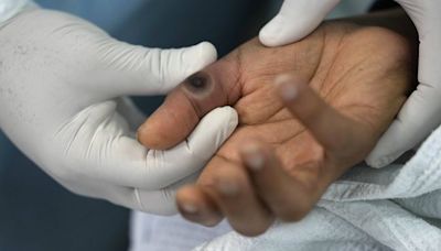 Mpox : Alerte maximale à l’épidémie de variole du singe en Afrique