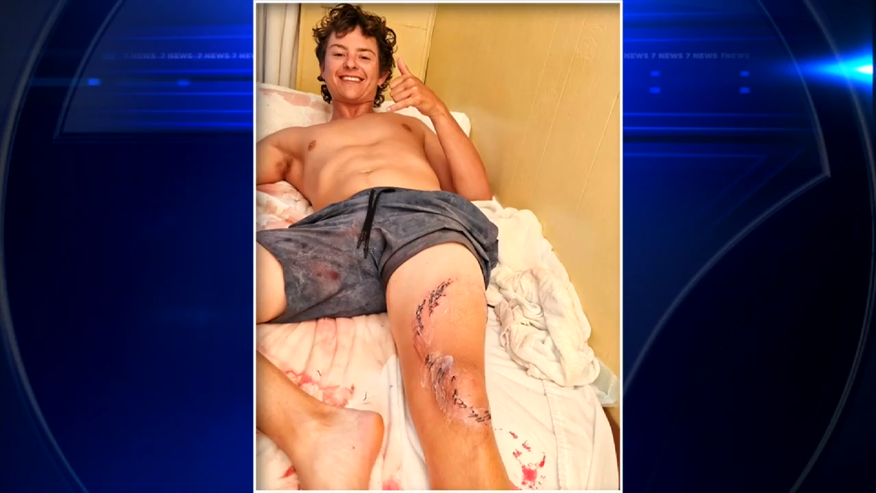 24-year-old man who was bitten by shark while in the Bahamas speaks out - WSVN 7News | Miami News, Weather, Sports | Fort Lauderdale