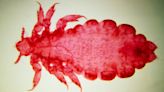 Do body lice spread plague? Science suggests the blood-suckers may have played a surprising role