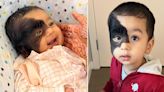 Mean people ask me if I caused my son's 'dog skin' birth mark