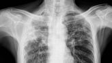 Union County high school student tests positive for tuberculosis. At least 270 exposed