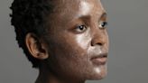 Everything Black Women Need To Know About Chemical Peels | Essence