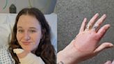 ‘Spot’ on woman’s finger turned out to be false widow spider bite