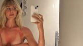 Diana Vickers goes topless as she displays her very sunburnt chest