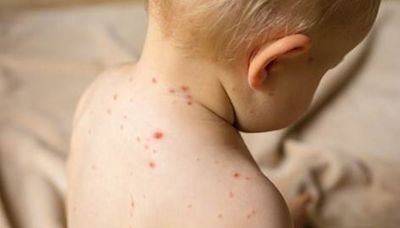 Child dies as almost 2,500 people infected with measles this year