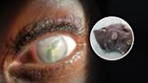 Woman discovers "worm-like" parasite living in eye for two years