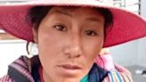 Pisco: niña con “piel de mariposa” necesita ser referida a un hospital de mayor complejidad en Lima