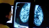 Radiotherapy ‘does not improve breast cancer survival after 30 years’