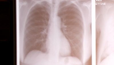 國人10大癌症死因肺癌第1 高風險族群可公費檢查