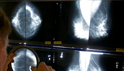San Diego advocates criticize new breast cancer screening guidelines