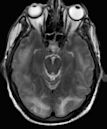 Posterior reversible encephalopathy syndrome