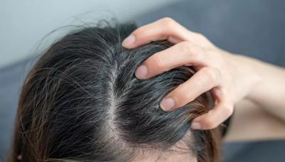 Old-school dandruff treatment resurfaces and people have been wowed by its results