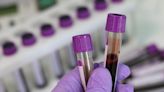 Blood test measuring DNA damage may help diagnose Parkinson's disease