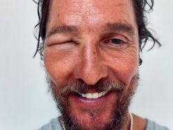 Matthew McConaughey a été défiguré par une piqûre d'abeille