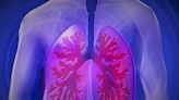 Cómo funcionan los marcadores proteínicos que predicen el cáncer de pulmón