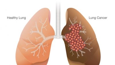 明明是肺癌，為什麼用抗甲狀腺癌藥物來治療? 什麼是跨癌別特定基因？