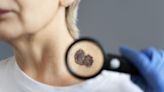 El melanoma no siempre aparece en la piel y a veces no produce síntomas: ¿cómo detectarlo a tiempo?