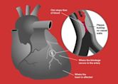 Acute coronary syndrome