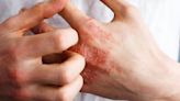 Atopic dermatitis found to negatively impact mental health