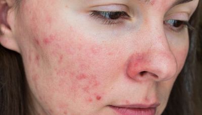 Doxycycline for Rosacea: A Pharmacist Explains