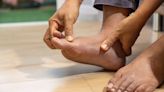 Signs and Symptoms of Gout