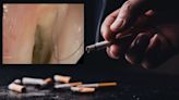 Austria: 52-Year-Old Smoker Develops Hair Inside Throat, Plucks Hair For 14 Years As It Kept Growing