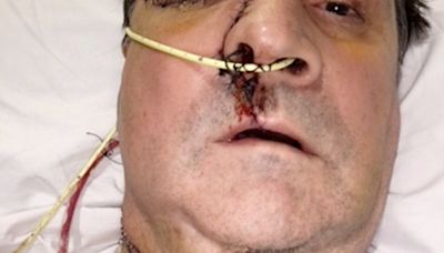 Dad had half his face removed after dog sniffed out tumour given 2nd chance