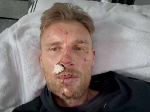 Freddie Flintoff shows off full extent of horrific injuries from car crash