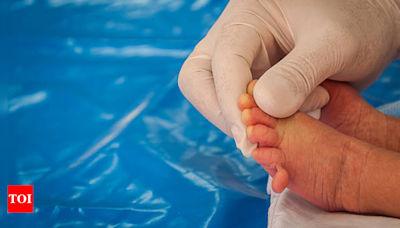 Baby born with Polydactyly condition, has 25 fingers and toes: Know why this happens in newborns - Times of India