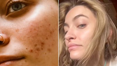 Paris Jackson Shares Unfiltered Photo of Her Acne and the Skincare Routine That Helped Her Breakouts