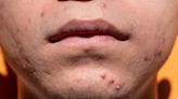 Accutane comes out on top in comparison of acne treatments